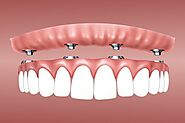 Embrace Wholeness with All-on-4 Dental Implants in Melbourne
