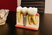 How to Care for Dental Implants in Melbourne?