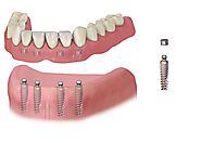 Why All On 4 Dental Implants Is Best Choice For You