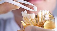 Unveiling the Excellence of Dental Implants for Melbourne Locals