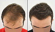Major Pros and Cons of Hair Transplant Everyone Should Know in 2021