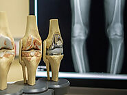 Website at https://www.drkasha.com/bone-deformity-corrections-hyderabad.html