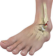 Ankle Fracture Surgeon in Delhi, India