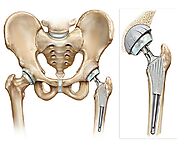 Hip Replacement Doctor in Faridabad