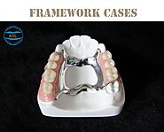 Removable Restoration | Advanced Dental Laboratory