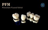 Porcelain Fused Metal | Chinese Dental Lab