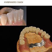 Composite | Digital Dental Lab Chinese