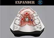 Orthodontic Expander | China Dental Laboratory