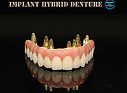 Implant Hybrid Denture | Advance Dental Lab China