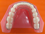 Retainer | Implant Dental Lab in China