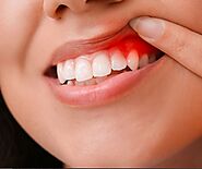 What is Gum disease?