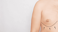 Gynecomastia Surgery: How It Gives You A Perfect Look?
