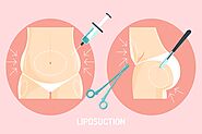 Vaser Technology: High Definition Liposuction and Its Benefits