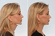 Neck Lift Surgery Procedures