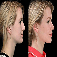 Chin Augmentation Treatment