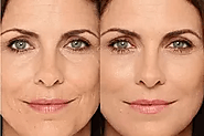 Liquid Facelift Treatment