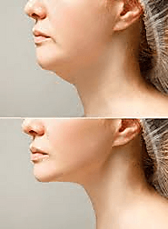 Double Chin Liposuction Procedure