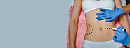 Can One Gain Weight After Liposuction Surgery?