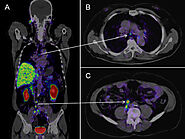 Does a PET scan show all cancers?