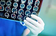 TMS for Stroke Recovery: A Comprehensive Guide - LifeQuality TMS NYC