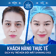 Điều trị thâm hốc mắt