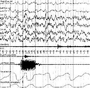 Sleep Study Treatment in Nashik | Sleep Study Diagnosis in Nashik