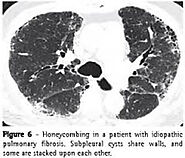 Best Interstitial Lung Disease Hospital Nashik