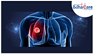 Best Lung Cancer Treatment In India | EdhaCare