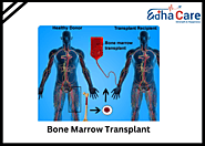 Bone Marrow Transplant In India | EdhaCare