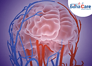 Brain Hemorrhage : Causes, Treatment & Symptoms | EdhaCare