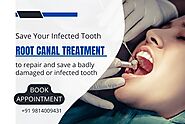 Stages of root canal treatment?