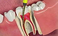 Basics of root canal treatment - Dental consultation