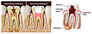 Root Canal Treatment In Oshawa & Scarborough | Root Canal Specialist In Oshawa & Scarborough-Grandview Dental Clinic