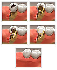 St. Catharines Root Canal Therapy | Niagara Root Canal