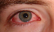 Bloodshot Eyes: Its Common Causes and Prevention