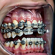 teeth braces in dubai