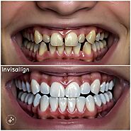 invisalign centre in dubai