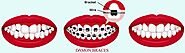 What are Damon Braces By Dental Botique