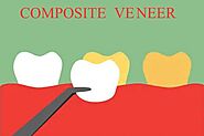 What is Composite Veneer By Dental Boutique