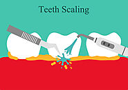 Teeth Scaling Procedure by Dental Boutique