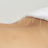 Acupuncture for Back Pain Bronx - Acupuncture for Back Pain Stamford, CT
