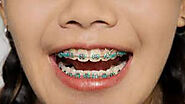 Invisalign Vs. Braces- Know the Difference Before Visiting A Dentist