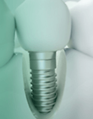 Why Visit a Certified Dental Surgeon for Implants?