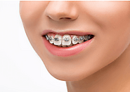 5 basic tips to follow for your braces