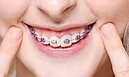 Everything you need to know about the Stages of a Braces Treatment – White House Dental