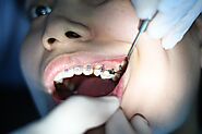 Top Tips to Maintain Dental Health While Wearing Braces...