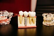 Factors You Should Consider To Choose The Right Type Of Dental Implant