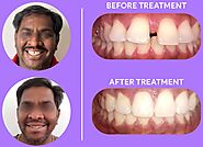 Orthodontic Braces Treatments