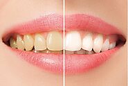 Laser Teeth Whitening, Teeth Bleaching Treatment