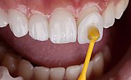 Dental Veneers Treatment